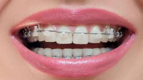 门牙牙缝2mm要多久矫正？矫正牙齿的方式分享